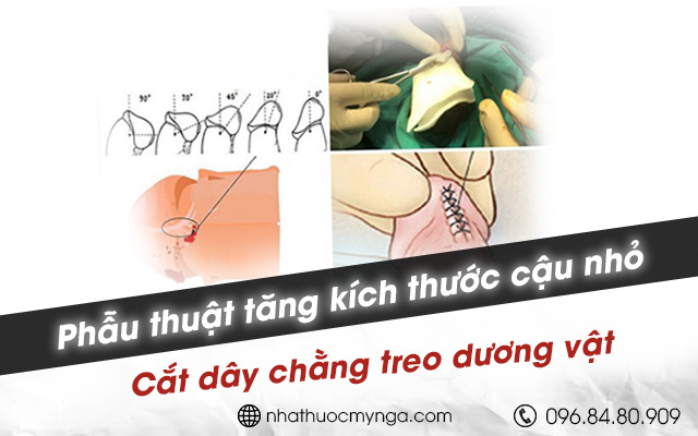 phẫu thuật tăng kích thước cậu nhỏ - Cắt dây chằng treo dương vật